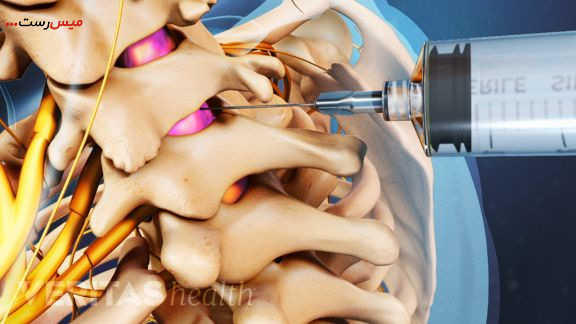 راه‌های درمان آرتروز گردن